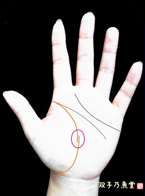 手相術・生命線が切れていて下の線が外側に重なっている例。