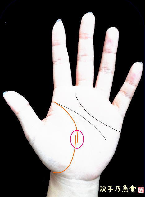 手相術・生命線が切れていて下の線が内側に重なっている例。